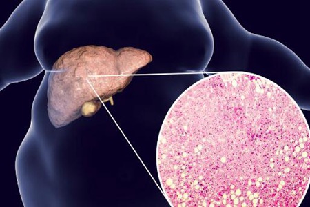 脂肪肝的危害有哪些？这五个危害并发症及时治疗