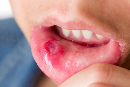 經常口腔潰瘍怎麼辦？這五個方法讓它快點消失