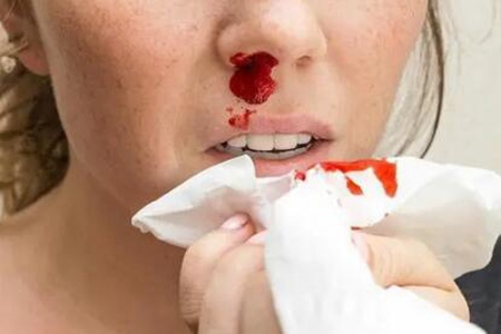 流鼻血怎么处理？如何预防流鼻血