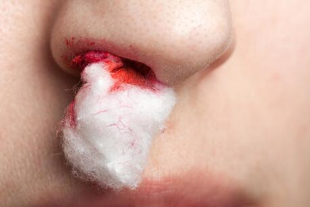 鼻子出血怎么止血？這五個正確的止血法安全健康